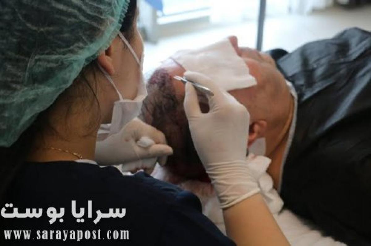 5 حقائق عن تقنية السفير Sapphire FUE لزراعة الشعر