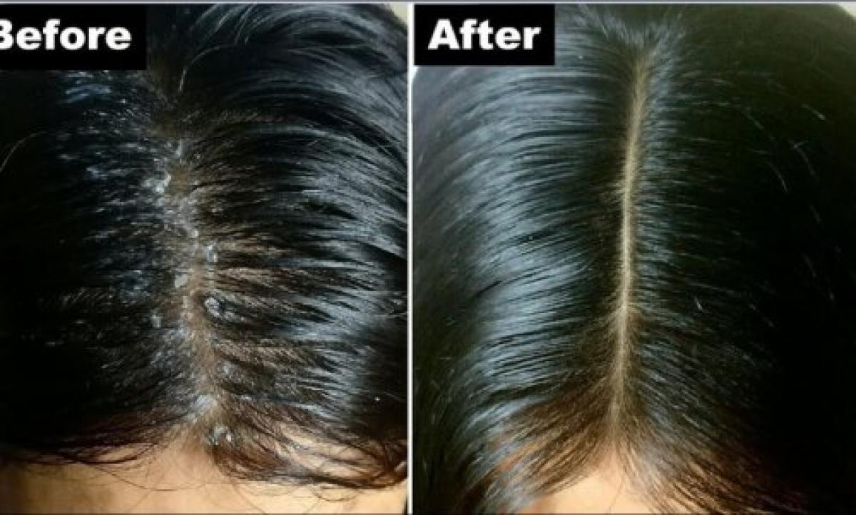 أهم الطرق الصحيحة في علاج قشرة الشعر عند النساء